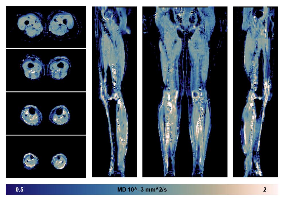 IVIM corrected whole leg muscle mean diffusivity obtained from diffusion tensor imaging.